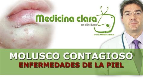 como eliminar molusco contagioso naturalmente|Combate los molestos Moluscos Contagiosos con。